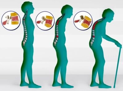 Остеопороз